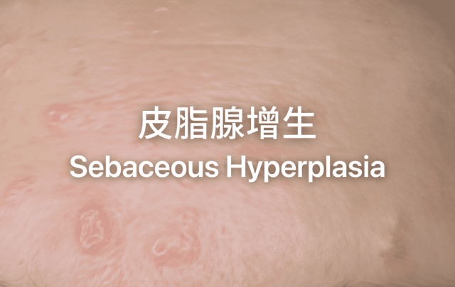 Sebaceous Hyperplasia